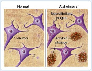 amyloid-plaques-in-alzheimers-disease