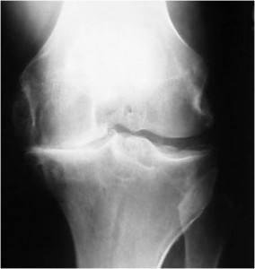 arthritis+knee